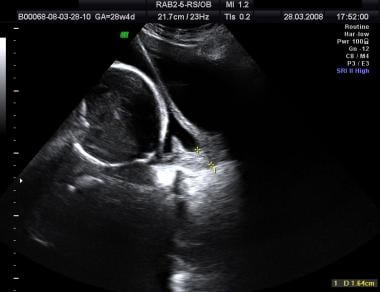 Ultrasound Evaluation of the Gravid Cervix