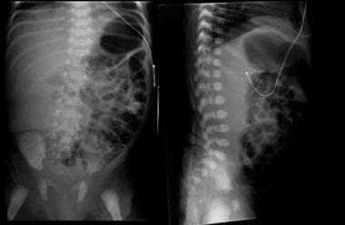 Kidney, ureter, and bladder (KUB) images of an inf