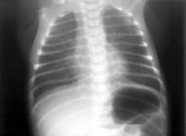 Transient tachypnea of the newborn. Radiograph of 