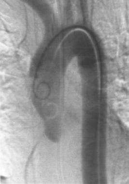 Aorta, trauma. Posteroanterior angiogram shows a s