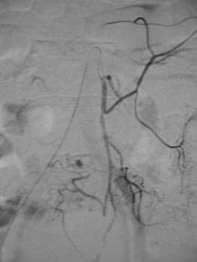 Inferior mesenteric arteriogram in a patient with 