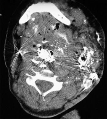 Axial CT image through the upper part of the neck 