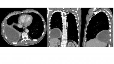 Chest CT scan with intravenous contrast (axial, co