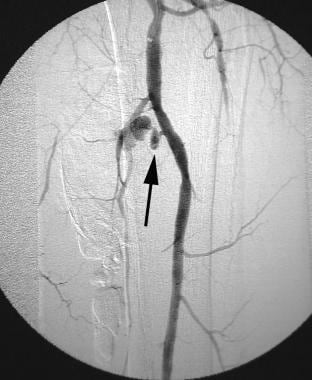 Digital subtraction left lower extremity angiogram