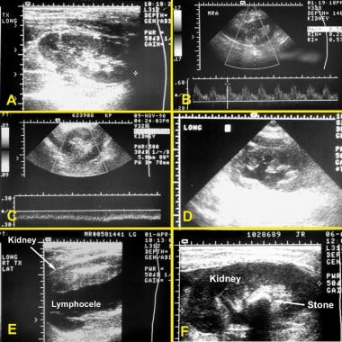 Kidney transplantation ultrasonograms. (A) Normal 