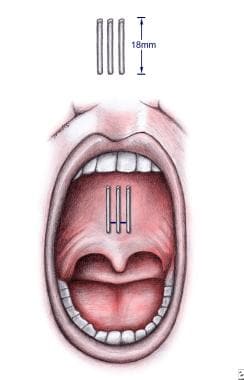 https://img.medscapestatic.com/pi/meds/ckb/32/24832tn.jpg