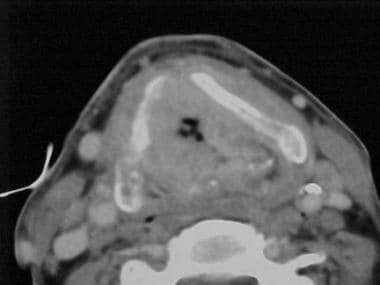 Preoperative CT scan image of the tumor shown in t