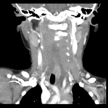 Coronal contrasted image from a 3-year-old child w