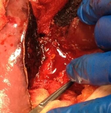 Brisk bleeding after the division of bile duct. 