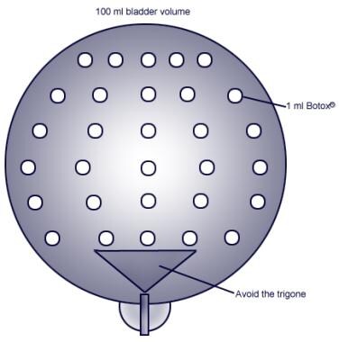 Injection sites using minimally invasive outpatien