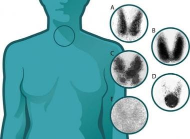 Five different scintigrams taken from thyroids wit