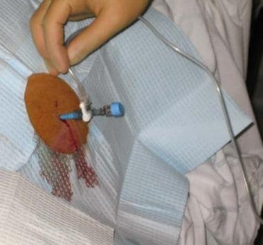 Paracentesis. Connection of collecting tube. 
