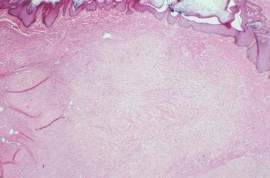 Histology of keloid demonstrating central zone of 
