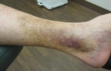 Venous stasis outlet dermatitis