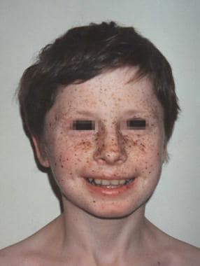 Multiple lentigines on the face of a child with LE