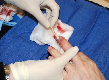 The wound can be covered with antibiotic ointment 