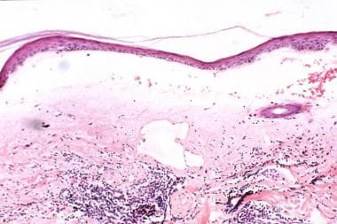 Typical lichen sclerosus histology demonstrating h