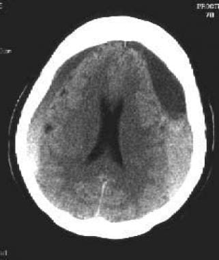 Chronic subdural hematomas (SDHs) are commonly bil