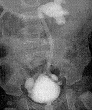 Diverticula of the bladder in a boy with Menkes di