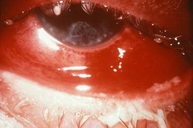 Conjunctivitis. Courtesy of Wikipedia Commons. 