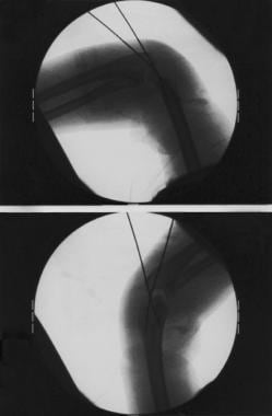 Intraoperative fluoroscopic radiograph of Kirschne