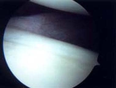 Labral features characteristic of multidirectional