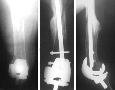 Fracture around stable prosthesis treated with rig