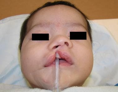 The nasal cartilage is displaced laterally, inferi