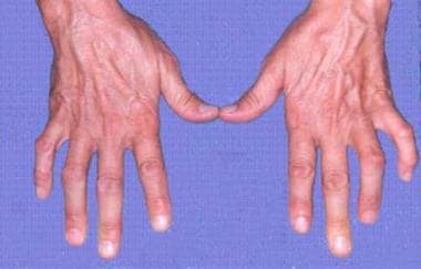 Ulnar clawing produced by loss of intrinsics to th