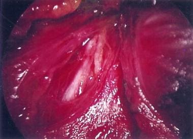 Identification of the recurrent laryngeal nerve du