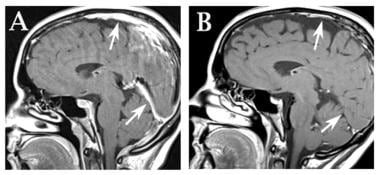 CSF hypotension syndrome: Postcontrast MRI before