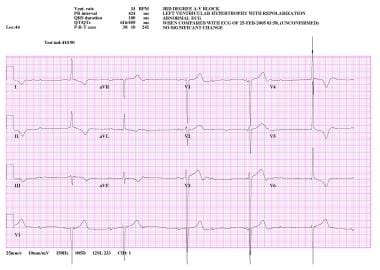 Electrocardiogram from patient in complete heart b
