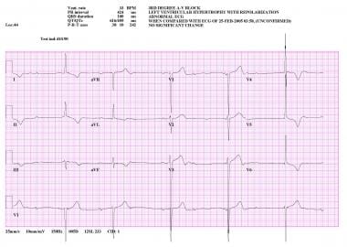 Delayed Total Atrioventricular Block After Transcatheter Aortic Valve Replacement Assessed by Implantable Loop Recorders