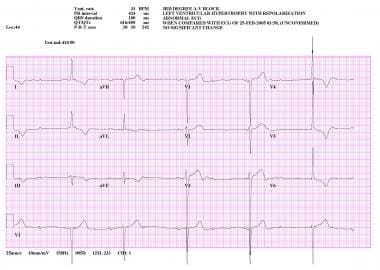 Incidence and predictors of developing high-degree AV block in patients