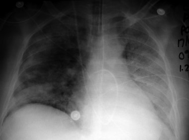 A 44-year-old woman developed acute respiratory fa
