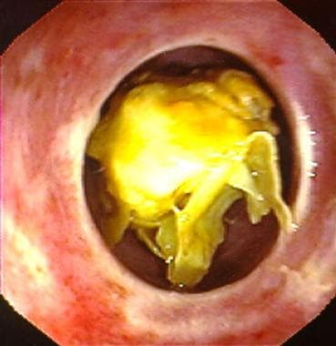 Lower Esophageal Ring - DoveMed