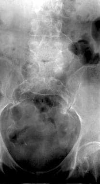 Radiograph shows calcification of abdominal aorta.
