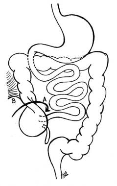 Cecal volvulus. (A) Clockwise torsion of mesentery
