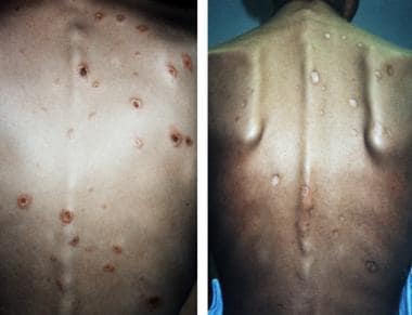 This photo depicts cutaneous disseminated sporotri