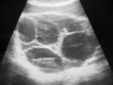 specimen of bilateral hemorrhagic ovarian cysts that ruptured that on