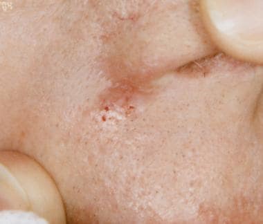 How Are Nodular Basal Cell Carcinoma Characterized