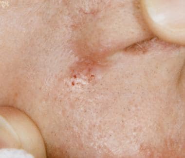 infiltrative basal cell carcinoma