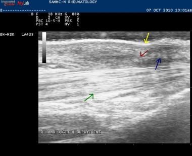 Ultrasound of the palm in Dupuytren disease of the
