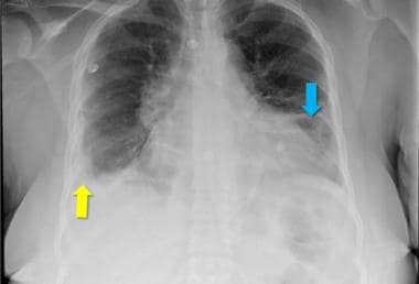 The chest x-ray from a patient with lupus demonstr