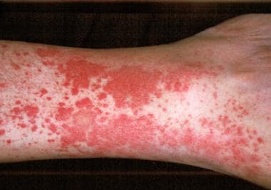 Hypersensitivity vasculitis. 