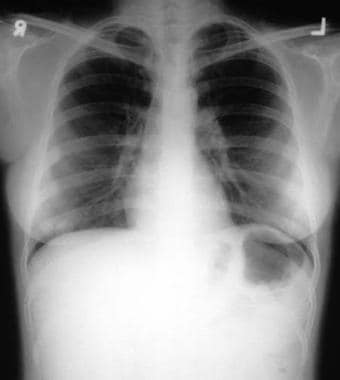 Posteroanterior chest radiograph showing a carcino