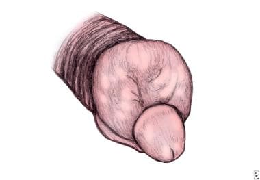 Illustration of paraphimosis. The foreskin is swol