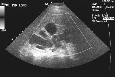 1340. Who needs imaging in UTI? / Pregnancy: UTI predisposing