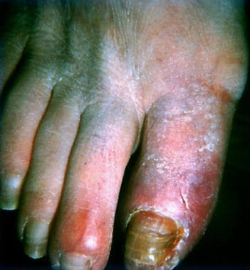 Superficial thrombophlebitis of great toe in patie