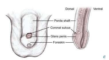 Phimosis: What is it, what causes it, when does it become serious, can it  be prevented?